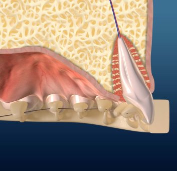 Visuel 3D en coupe d’une mâchoire pour expliquer des techniques de redressements de dents.